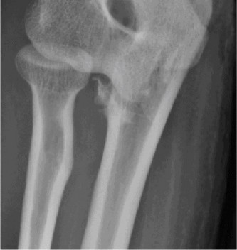 Illustration 5 for Complex Elbow Dislocation: Demystifying the Posteromedial Case