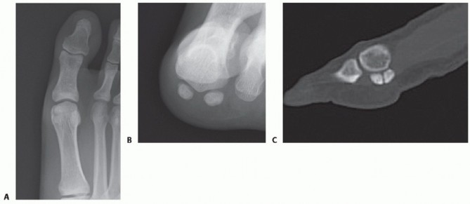 Illustration 16 for Optimizing Internal Fixation of Sesamoid Fractures