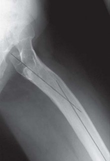 Illustration 12 for Successful Total Hip Replacement in Developmental Dysplasia