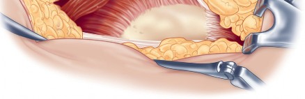 Illustration 36 for Direct Lateral Hip: Optimize Exposure with Sharp Curved Hohmann