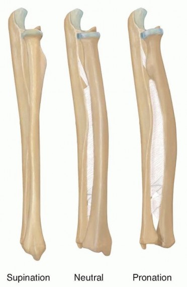 Corrective Osteotomy for Radius and Ulna Diaphyseal Malunions