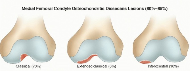 Illustration 4 for Dissecans of the Knee: What's the Difference – OCD vs. AVN?