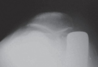 صورة طبية: تقويم مفصل الركبة أحادي الحجرة دليل شامل للمرضى في صنعاء