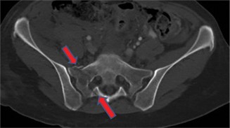 Challenging Case Sacral Fracture: Test Your Knowledge!