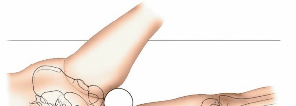 Illustration 60 for Optimal Femoral Approaches: Mastering the Lateral Intermuscular Septum