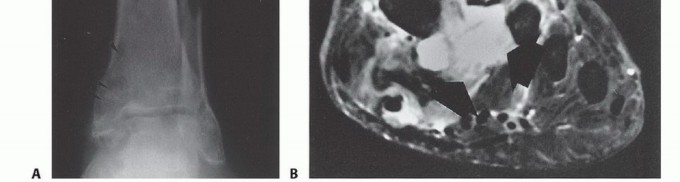 Illustration 7 for Below-Knee Amputation: Maximize Your Below-Knee Recovery & Function