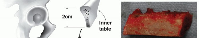Illustration 21 for Glenoid Bone Graft for Anterior Shoulder Instability: Restore Stability