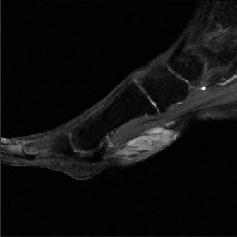 Illustration 5 for Foot Nodule Pain? Solutions for Masses along the Medial Cord
