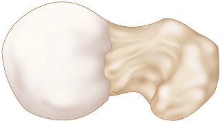 Illustration 3 for Cemented Femoral Stem Figures: Surgical Anatomy & Placement