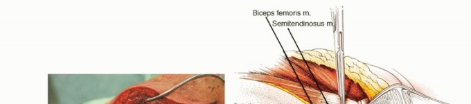 Illustration 15 for Posterior Thigh Resection: Rethinking Outcomes & Limb Sparing