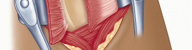 Illustration 25 for Mastering the Treatment of Recurrent Posterior Shoulder Instability