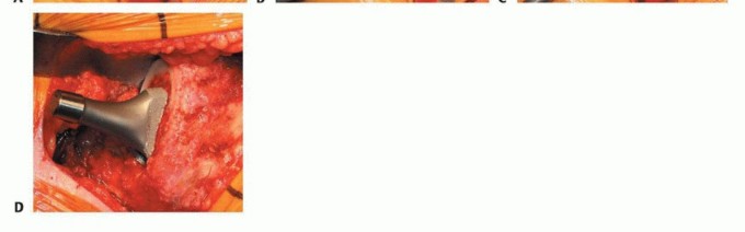 صورة طبية: استبدال مفصل الورك بدون أسمنت: استعادة الحركة والثبات في صنعاء مع الأستاذ الدكتور محمد هطيف