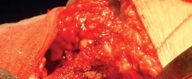 Illustration 22 for Approaches Posterolateral Surgical: A Guide to Enhanced Hip Surgery