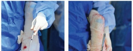 Illustration 10 for Cement in Cement Revision: Simplifying Complex Hip Revisions