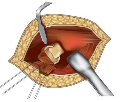 Illustration 16 for Metal on Metal Resurfacing: Enhanced Posterior Soft Tissue Repair