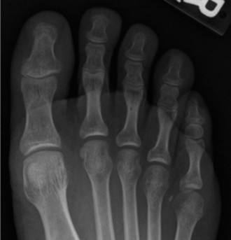 Illustration 3 for Medial and Lateral Foot Pain: Diagnosis & Imaging Insights