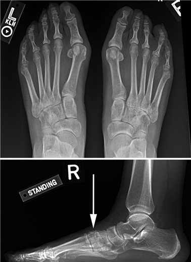 Illustration 42 for First Metatarsal Surgery: Expert Solutions for Foot & Ankle Pain