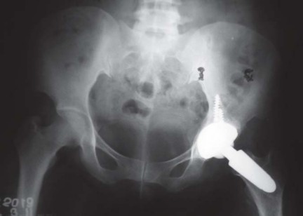 Illustration 71 for The Silent Hip: Achieving a Truly Silent, Pain-Free Joint