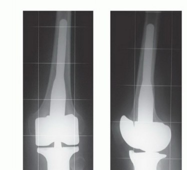 Illustration 48 for Tackling Complex Tumors of the Proximal Tibia: Limb-Sparing Solutions