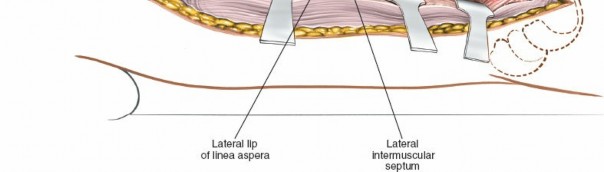 Illustration 25 for Optimal Femoral Approaches: Mastering the Lateral Intermuscular Septum