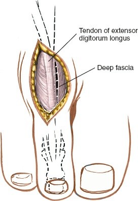 Illustration 218 for Optimized Approaches to the Dorsum of the Foot & Ankle