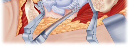 Illustration 30 for Cemented Component Longevity: The Critical Margin of the Acetabulum