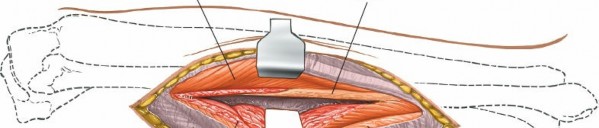 Illustration 81 for Surgical Access: Mastering the Tibia's Surface & Fibula Approaches