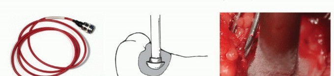 Illustration 13 for Avoid Major Surgery: Bone Tumor Treatment with Liquid Nitrogen Pour