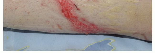 Illustration 29 for Avoid Major Surgery: Bone Tumor Treatment with Liquid Nitrogen Pour