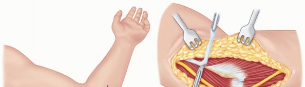 Illustration 54 for Surgical Approaches to Shoulder & Elbow: Pearls and Pitfalls