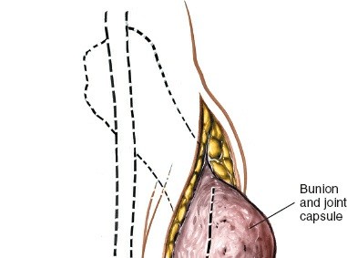 Illustration 195 for Optimized Approaches to the Dorsum of the Foot & Ankle