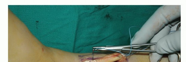 Illustration 49 for Foot Drop Surgery: How a Pin or Drill Elevates Tendon Transfer