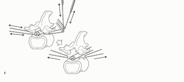 Illustration 18 for Total En Bloc Spondylectomy: Complete Resection for Spinal Tumors