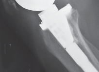 Illustration 71 for Mastering Gap Balancing in Revision TKA: Avoid Common Pitfalls