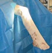 Illustration 5 for Optimizing Single-Bundle Anterior Cruciate Ligament Repair