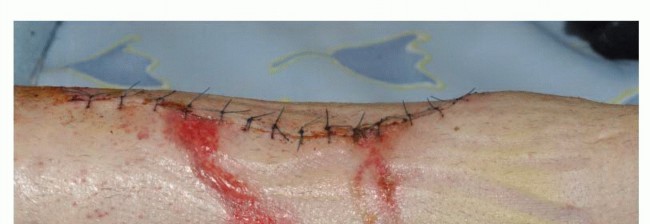 Illustration 28 for Avoid Major Surgery: Bone Tumor Treatment with Liquid Nitrogen Pour