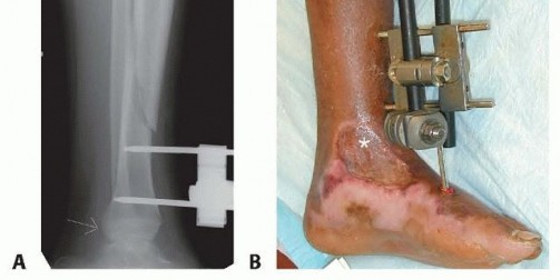 Illustration 7 for Optimal Treatment for Pediatric Tibial Fractures: Key Insights