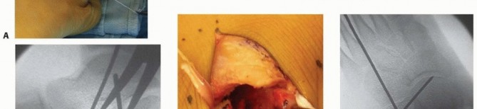 Illustration 14 for Calcaneal Lengthening Osteotomy: Correcting Hindfoot Valgus