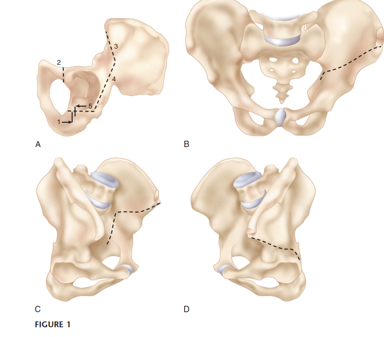 Illustration 2 for Bernese PAO: Unlocking the Procedure with Level V Evidence Insights