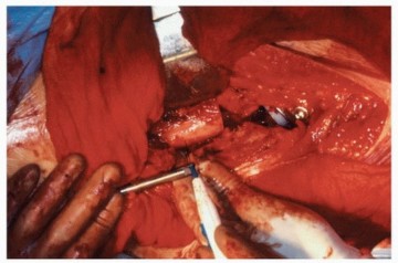 Illustration 23 for Recreate Hip Biomechanics: Modular Stems for Modular Solutions