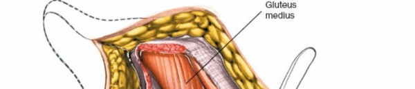 Illustration 41 for Unlocking Every Aspect of the Hip's Surgical Approaches