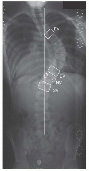 Spinal Fusion for Adolescent Idiopathic Scoliosis: What You Need to Know