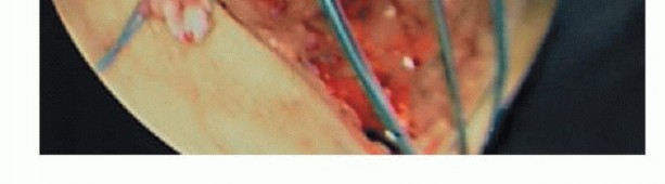 Illustration 9 for Repair & Recover from Collateral Ligament Injuries: Your Guide