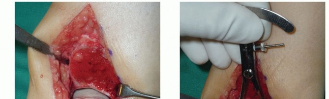 Illustration 7 for Unlock Healing: Medial Malleolar Osteotomy for Talus OLT Allografts
