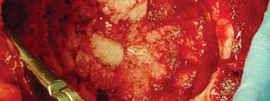 Illustration 26 for Expert Bone Grafting for Primary Total Hip Replacement Success