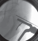 Illustration 22 for Increased Femoral Anteversion: A Proximal Femoral Rotational Osteotomy