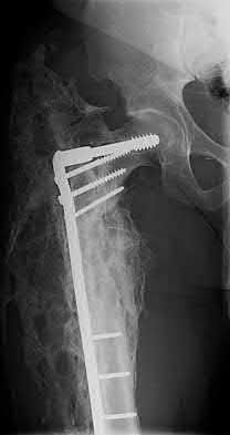 Illustration 202 for OrthoCash: Trauma MCQs & Cases for a yearold woman