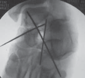 Illustration 5 for Talar Neck Fracture Treatment: Optimizing Recovery with ORIF
