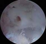 Illustration 47 for Precision Arthroscopy for Chondral Injuries & OCD: Direct Lateral Portal