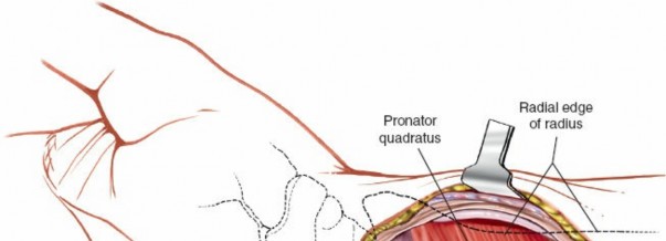Illustration 8 for Volar Approach: Optimal Exposure for the Volar aspect of the Distal Radius